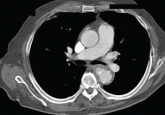 Salmonella-related mycotic pseudoaneurysm