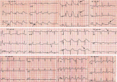Chest pain followed by sudden collapse