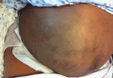 A 57-year-old woman with abdominal pain