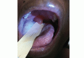A woman with a swollen uvula
