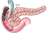 Endoscopic therapy of recurrent acute pancreatitis