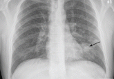 A 37-year-old man with a chronic cough
