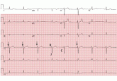Light-headedness and bradycardia in a 72-year-old woman