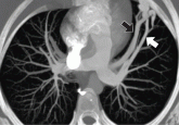 When does chest CT require contrast enhancement?