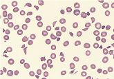 Thrombotic thrombocytopenic purpura: The role of ADAMTS13