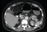 Bilateral adrenal masses