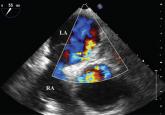 An 85-year-old woman with respiratory failure and positional hypoxemia