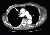 Superior vena cava syndrome
