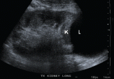 High creatinine 6 months after renal transplant