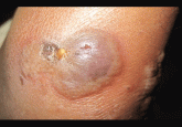 Dermatitis in an intestinal transplant candidate