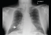 A 78-year-old smoker with an incidental pulmonary mass