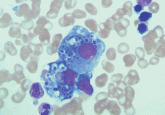 A 54-year-old woman with pancytopenia