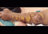Multiple huge bullae after renal transplant