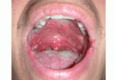 Oral plaques and dysphagia in a young man