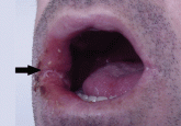 A nonhealing oral ulcer in a man with HIV