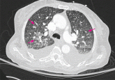 Diffuse reticulonodular infiltrates