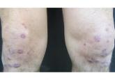 A man with HIV and papules and nodules on the knees