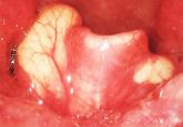 Epiglottic cysts in clinical practice