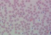An abnormal peripheral blood smear and altered mental status
