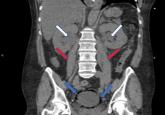 Emphysematous cystitis