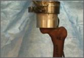 Biomechanical Evaluation of Proximally Placed Femoral Less-Invasive Stabilization System Plates