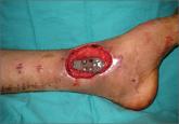 Use of Cross-Leg Flap for Wound Complications Resulting From Open Pilon Fracture