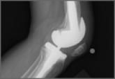 Failure of the Stem-Condyle Junction of a Modular Femoral Stem in Revision Total Knee Arthroplasty