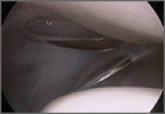 Medial Patellar Subluxation: Diagnosis and Treatment