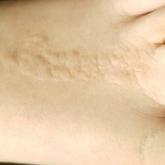 All the Little Lesions in a Row All the Little Lesions in a Row