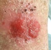 Biopsy? What Biopsy? Biopsy? What Biopsy?