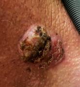 Neck lesion Neck lesion