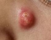 A Lesion Hits Its Growth Spurt A Lesion Hits Its Growth Spurt