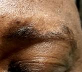 The Case of the Disappearing Eyebrows The Case of the Disappearing Eyebrows