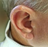 Lesion on ear Lesion on ear