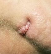 Chin lesion Chin lesion