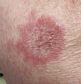 Lesion