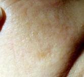 Cheek lesion Cheek lesion