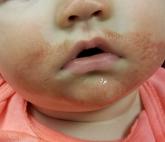 Baby’s Rash Causes Family Feud Baby’s Rash Causes Family Feud