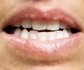 Blips on Lips Red vascular streaks on upper and lower lips