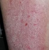 Start From Scratch Rash on right leg