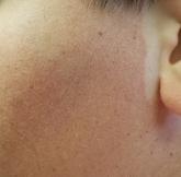 Boy, Is My Face Red! Rough skin on boy's face