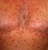 Itchy, bumpy rash on chest Itchy, bumpy rash on chest