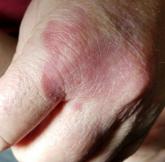 Hand rash Hand rash