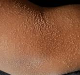 "Rash" on arm "Rash" on arm