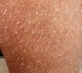 Rough lesions on leg Rough lesions on leg