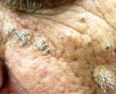 When Skin Damage Takes Sides When Skin Damage Takes Sides