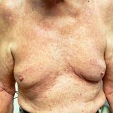 Chest rash Chest rash
