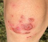 Knee lesions