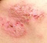 Back rash Back rash
