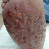 Eumycetoma Pedis in an Albanian Farmer